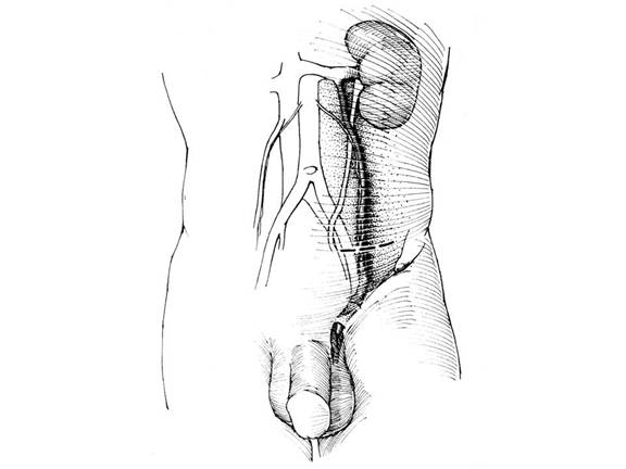 vein drainage w Palomo incision