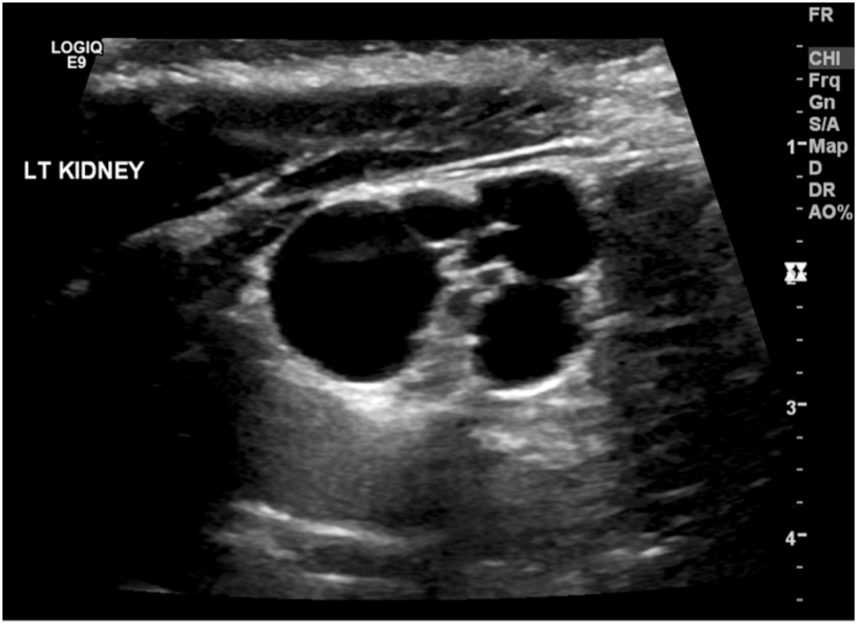 Multicystic dysplastic kidney